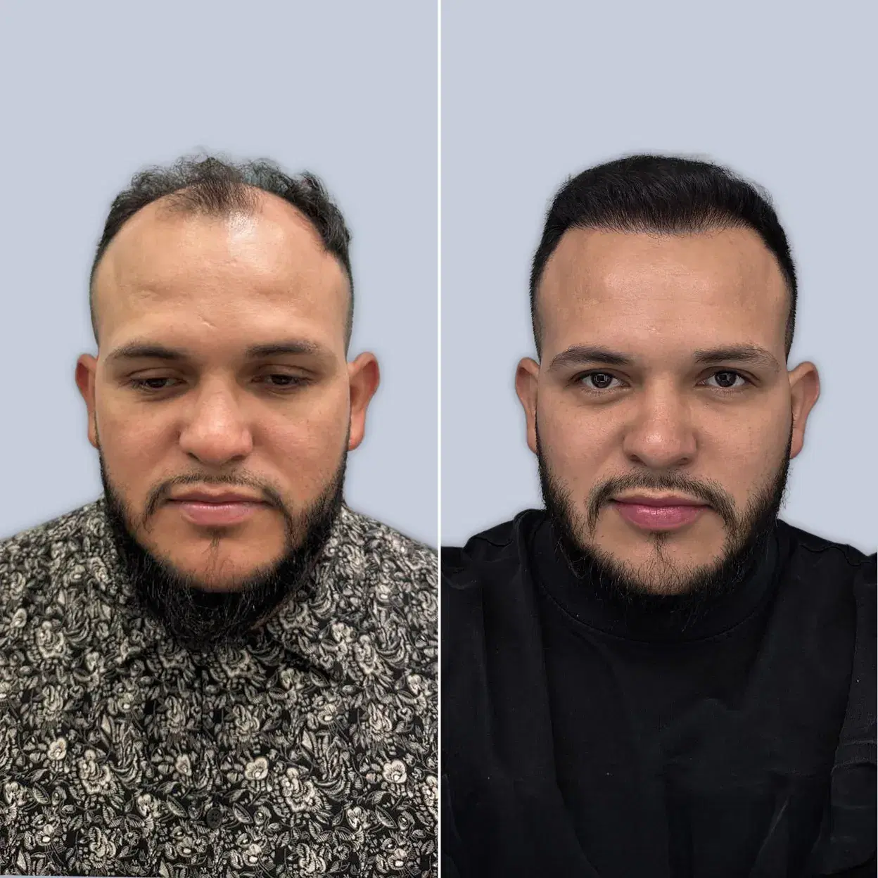 before after