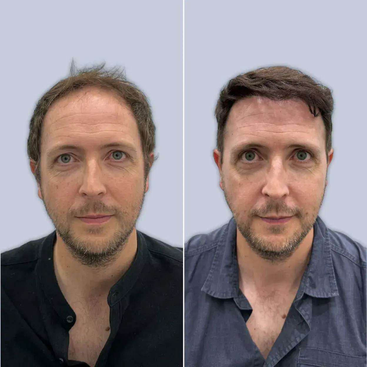 before after