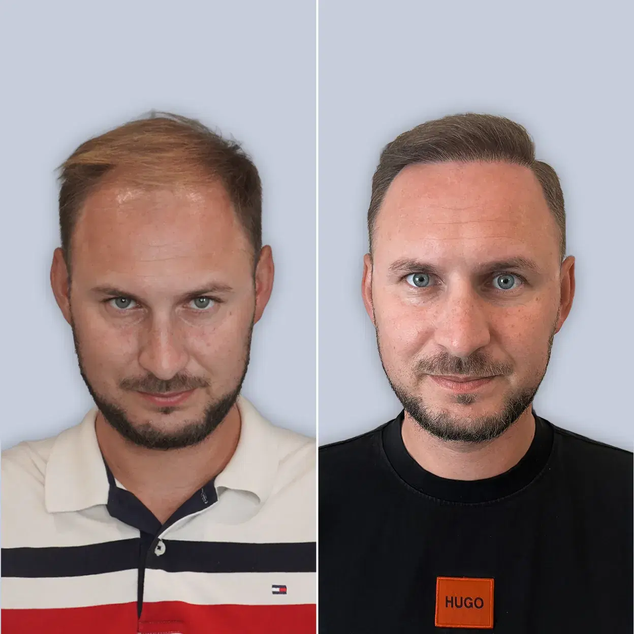before after
