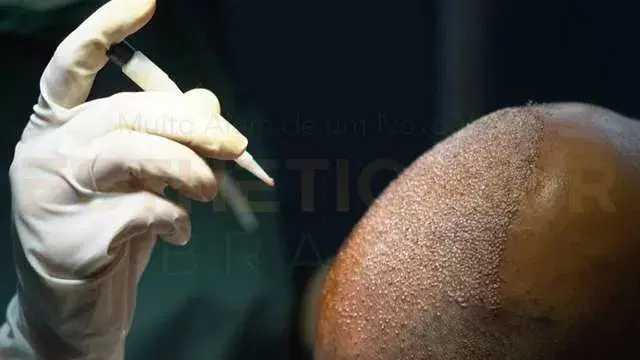 DHI Hair Transplant