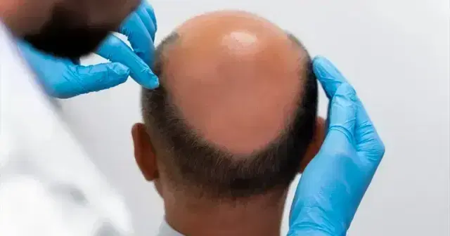 Técnica FUE