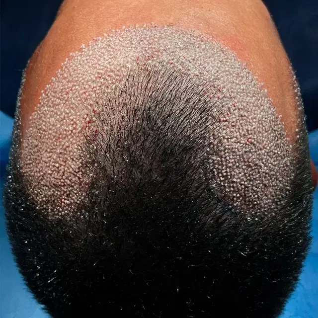 Transplante De Cabelo Sem Raspado