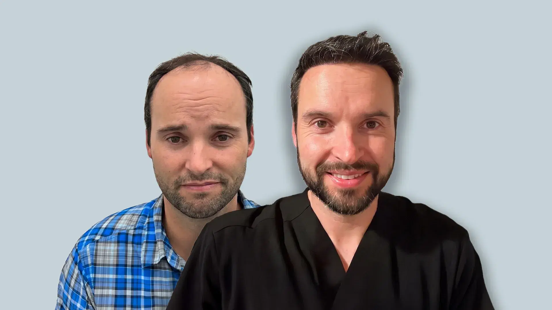 Hair Transplant