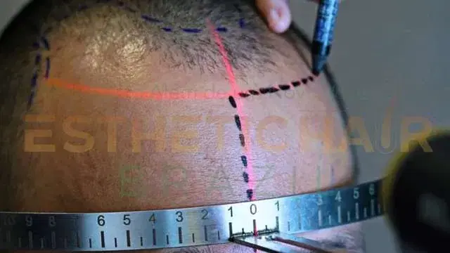 Coisas A Considerar Antes Do Transplante De Cabelo