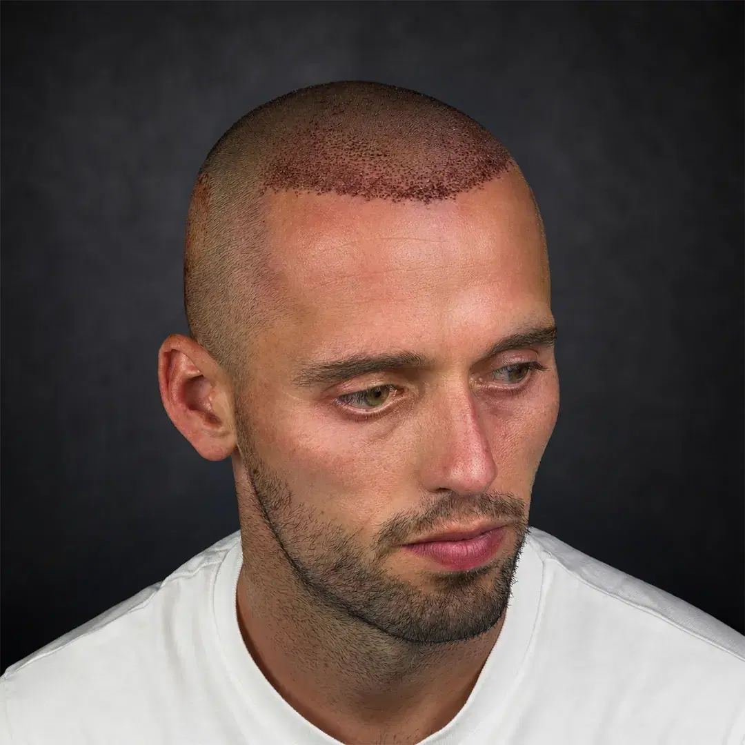 DHI Hair Transplant
