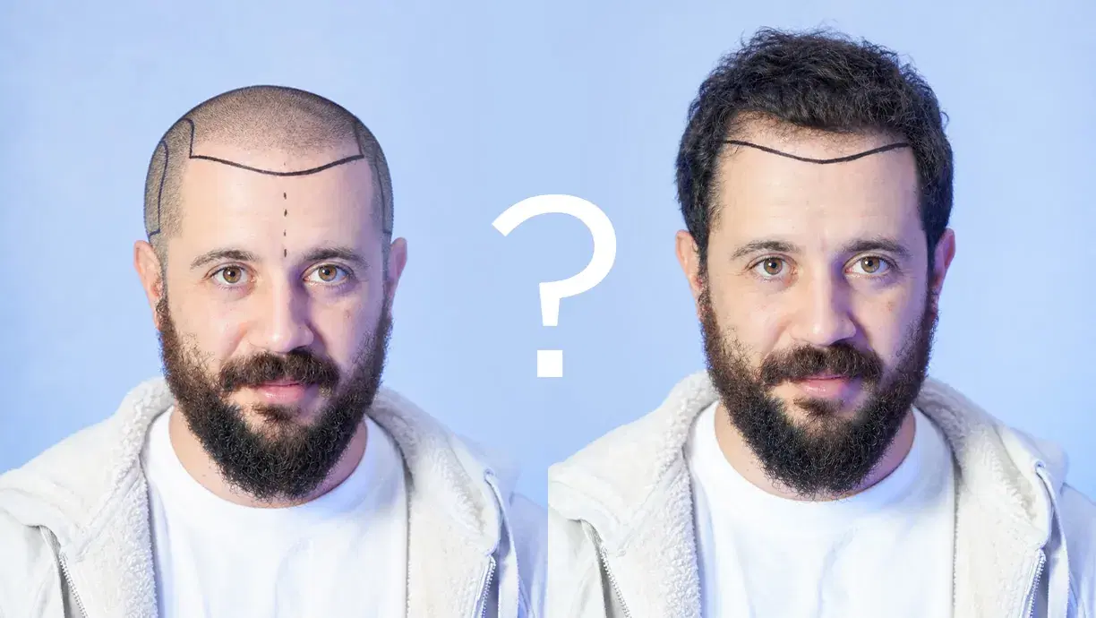 TRANSPLANTE DE CABELO SEM RASPADO