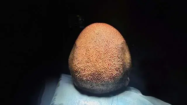 Sapphire FUE Antes e Depois do Transplante Capilar