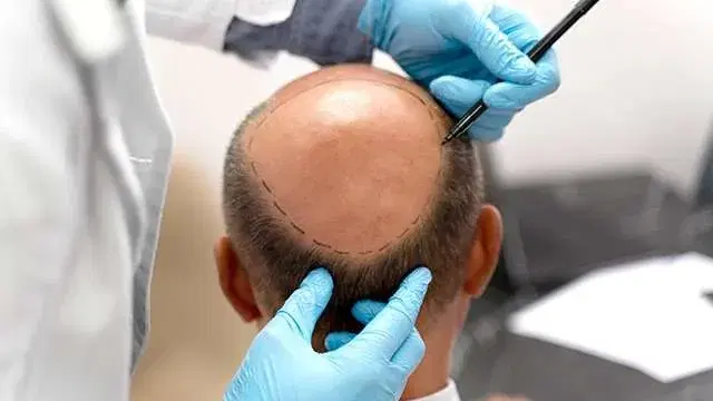 etapas-do-procedimento-de-transplante-capilar